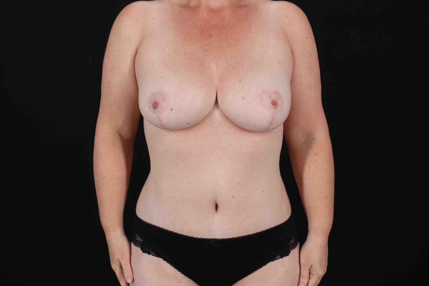 Mommy Makeover Before & After Patient #1342