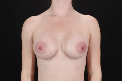 Breast Augmentation with Implants Before & After Patient #1247