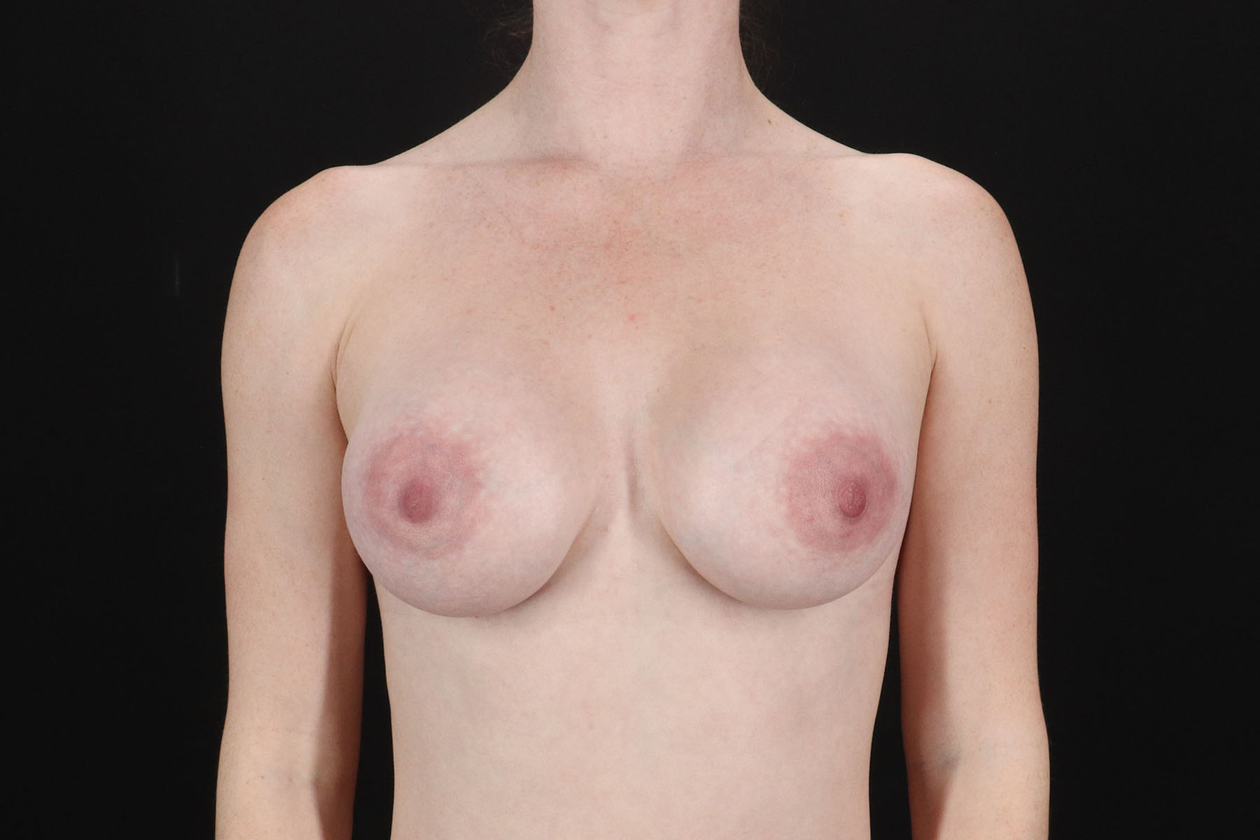 Breast Augmentation with Implants Before & After Patient #1247