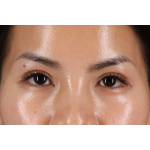 Eyelid Surgery Before & After Patient #1935