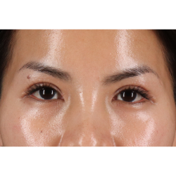 Eyelid Surgery Before & After Patient #1935