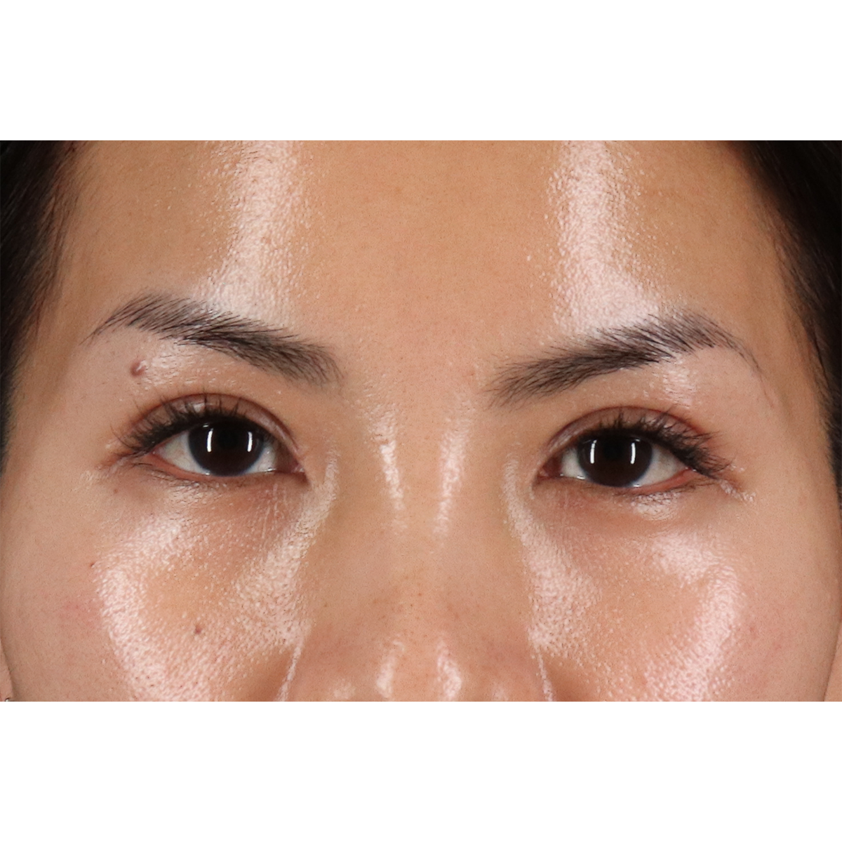 Eyelid Surgery Before & After Patient #1935
