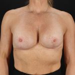 Breast Lift Before & After Patient #1060