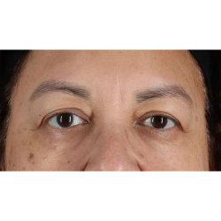 Eyelid Surgery Before & After Patient #2001