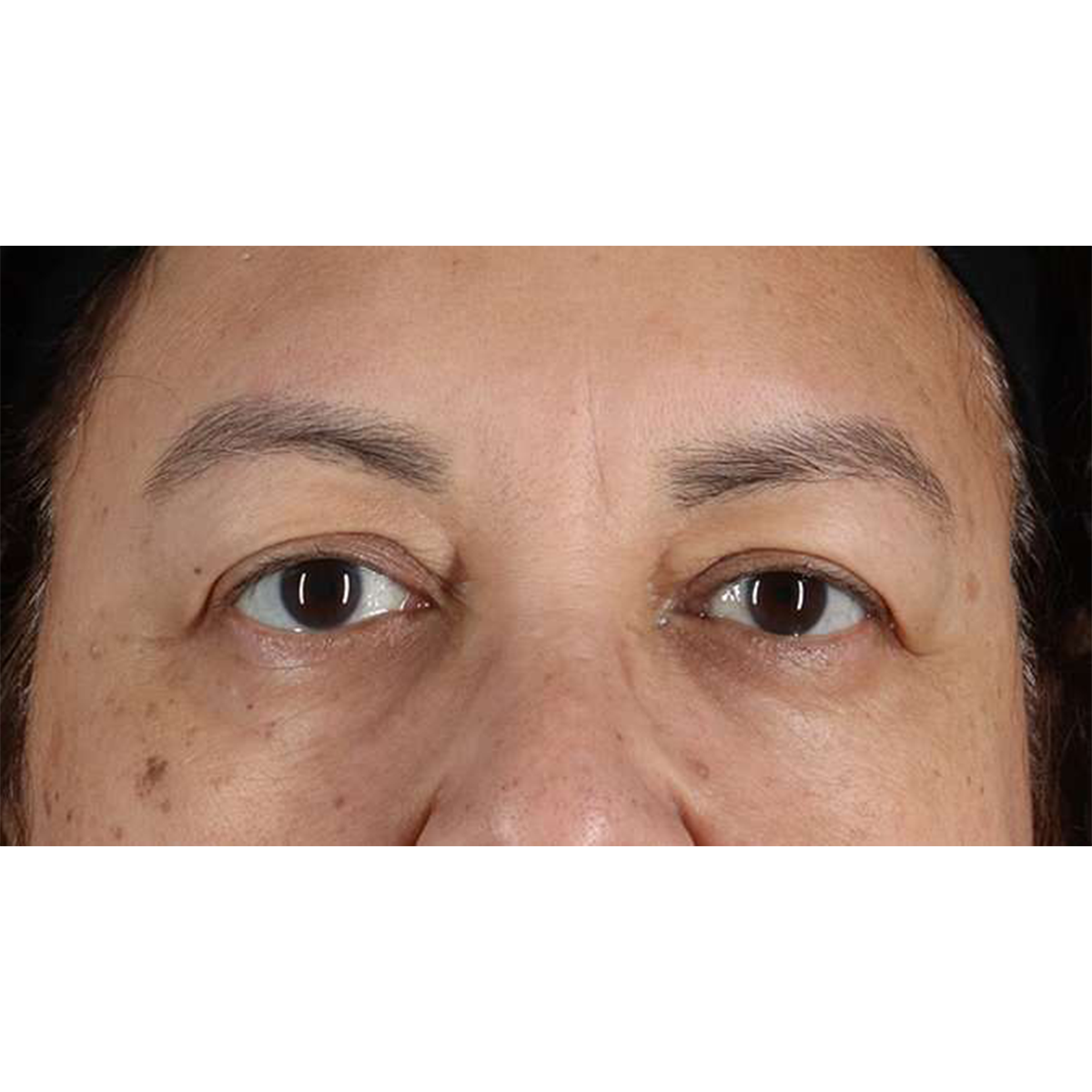 Eyelid Surgery Before & After Patient #2001
