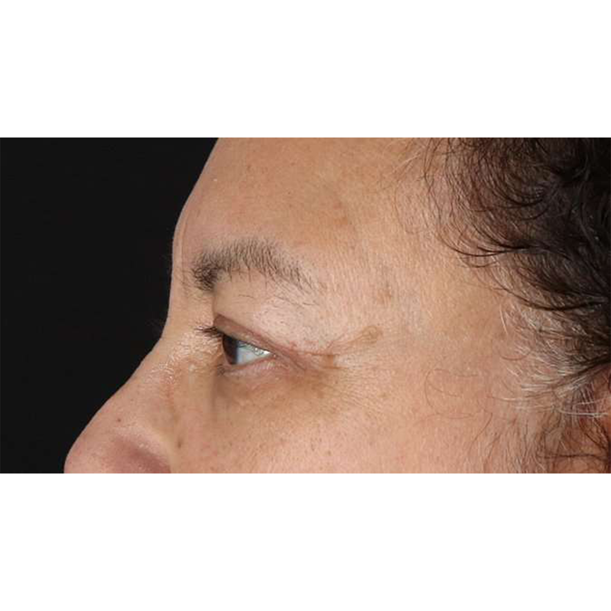 Eyelid Surgery Before & After Patient #2001