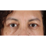 Eyelid Surgery Before & After Patient #2001