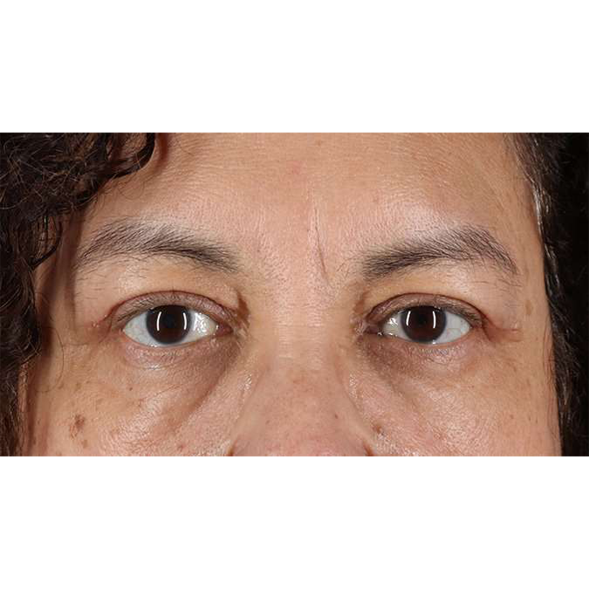 Eyelid Surgery Before & After Patient #2001