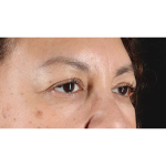 Eyelid Surgery Before & After Patient #2001