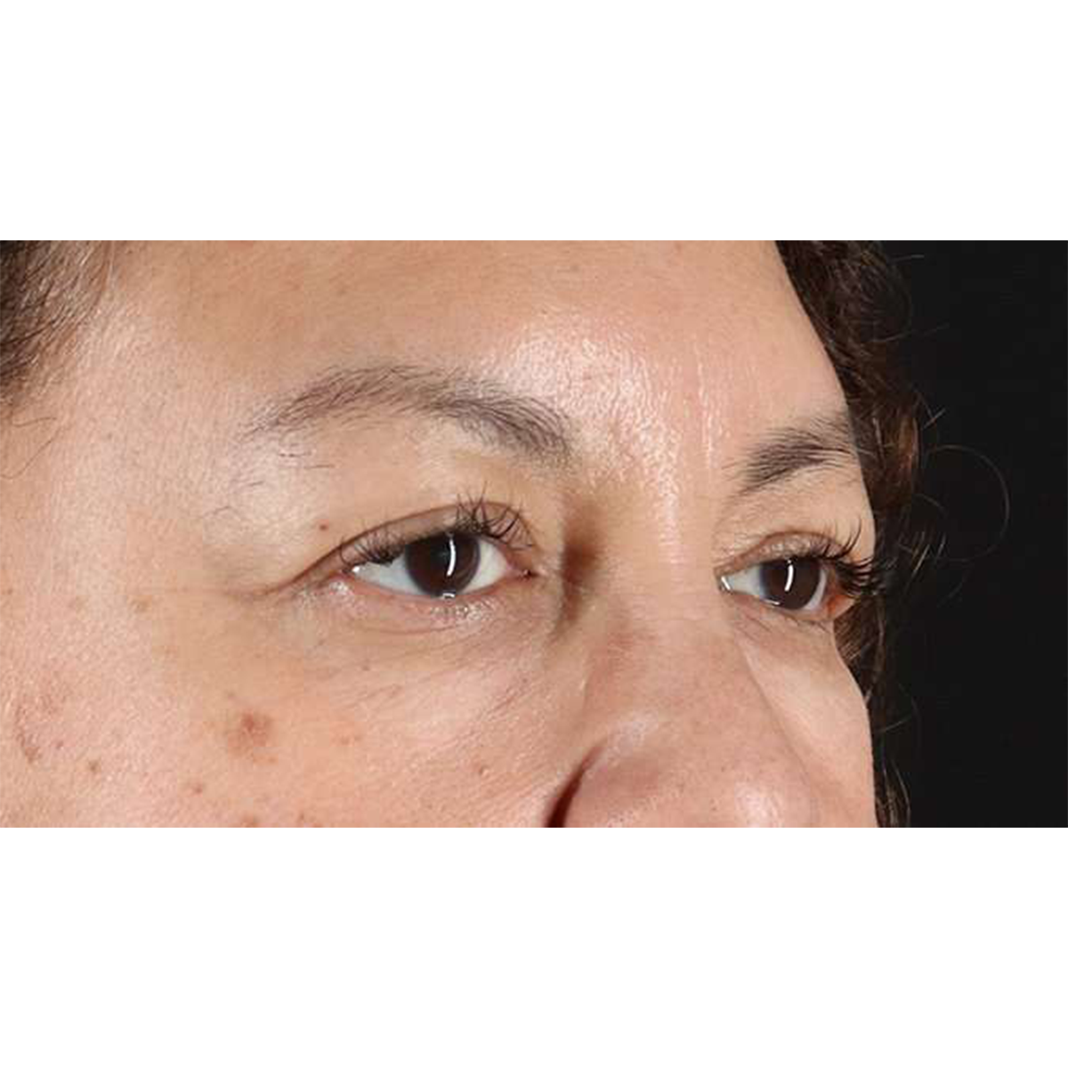Eyelid Surgery Before & After Patient #2001