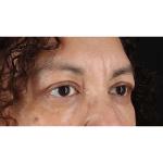 Eyelid Surgery Before & After Patient #2001