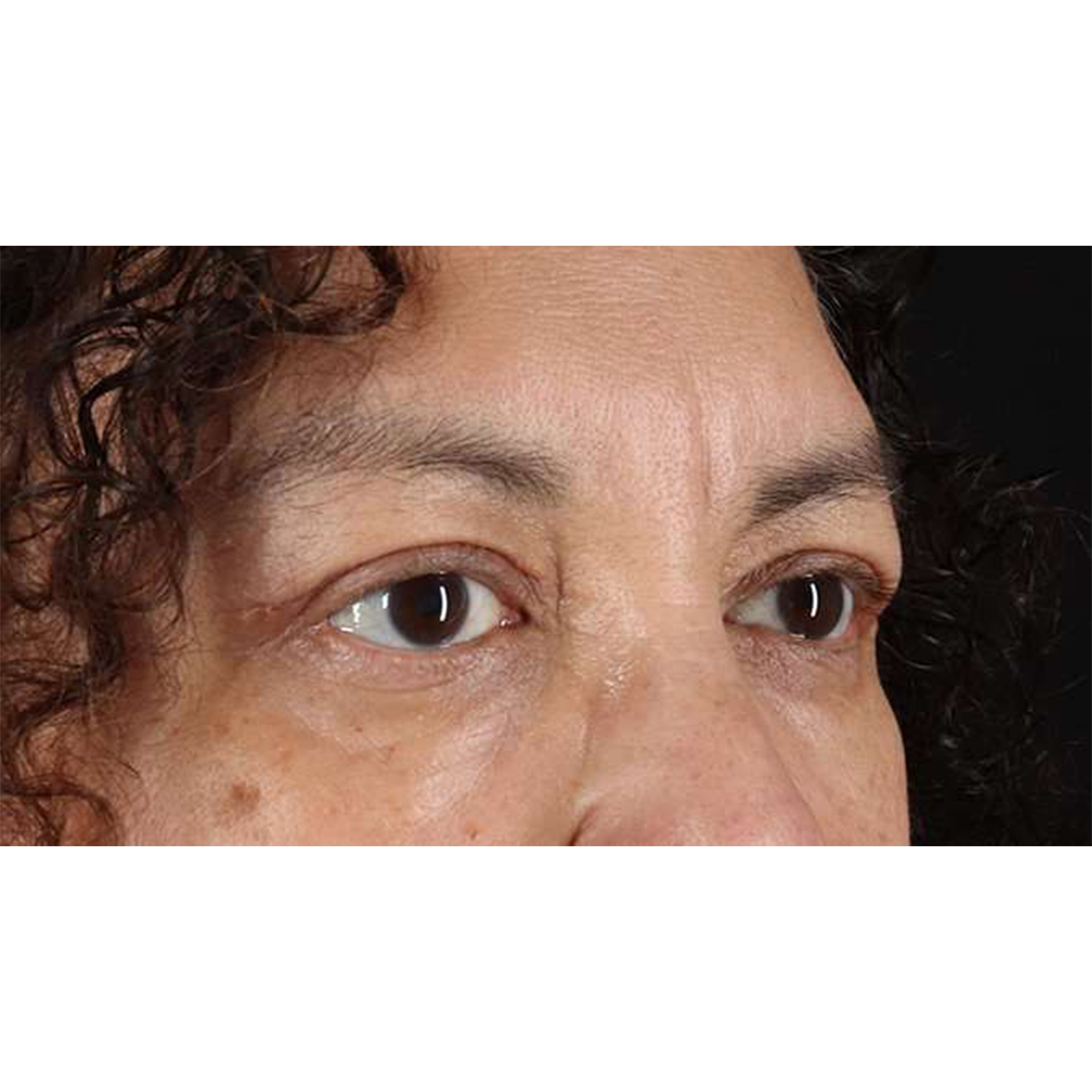 Eyelid Surgery Before & After Patient #2001