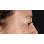 Eyelid Surgery Before & After Patient #2001