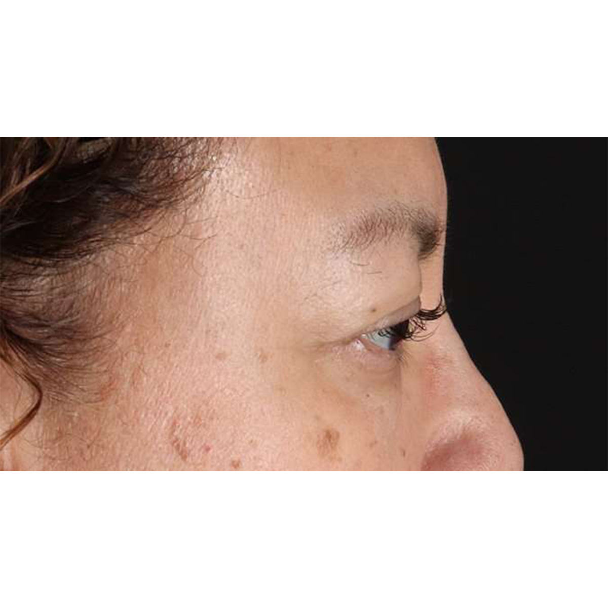 Eyelid Surgery Before & After Patient #2001