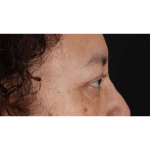 Eyelid Surgery Before & After Patient #2001