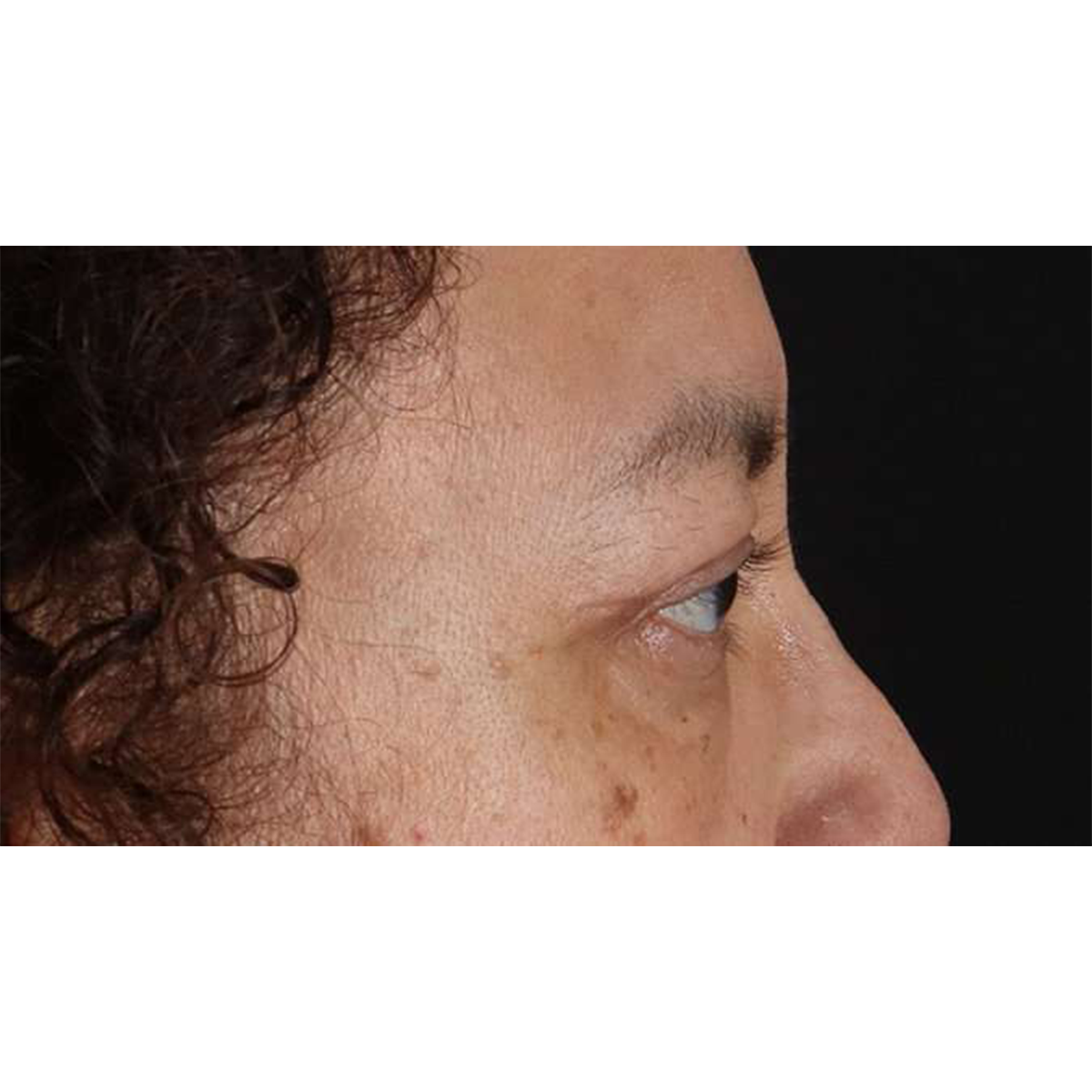 Eyelid Surgery Before & After Patient #2001