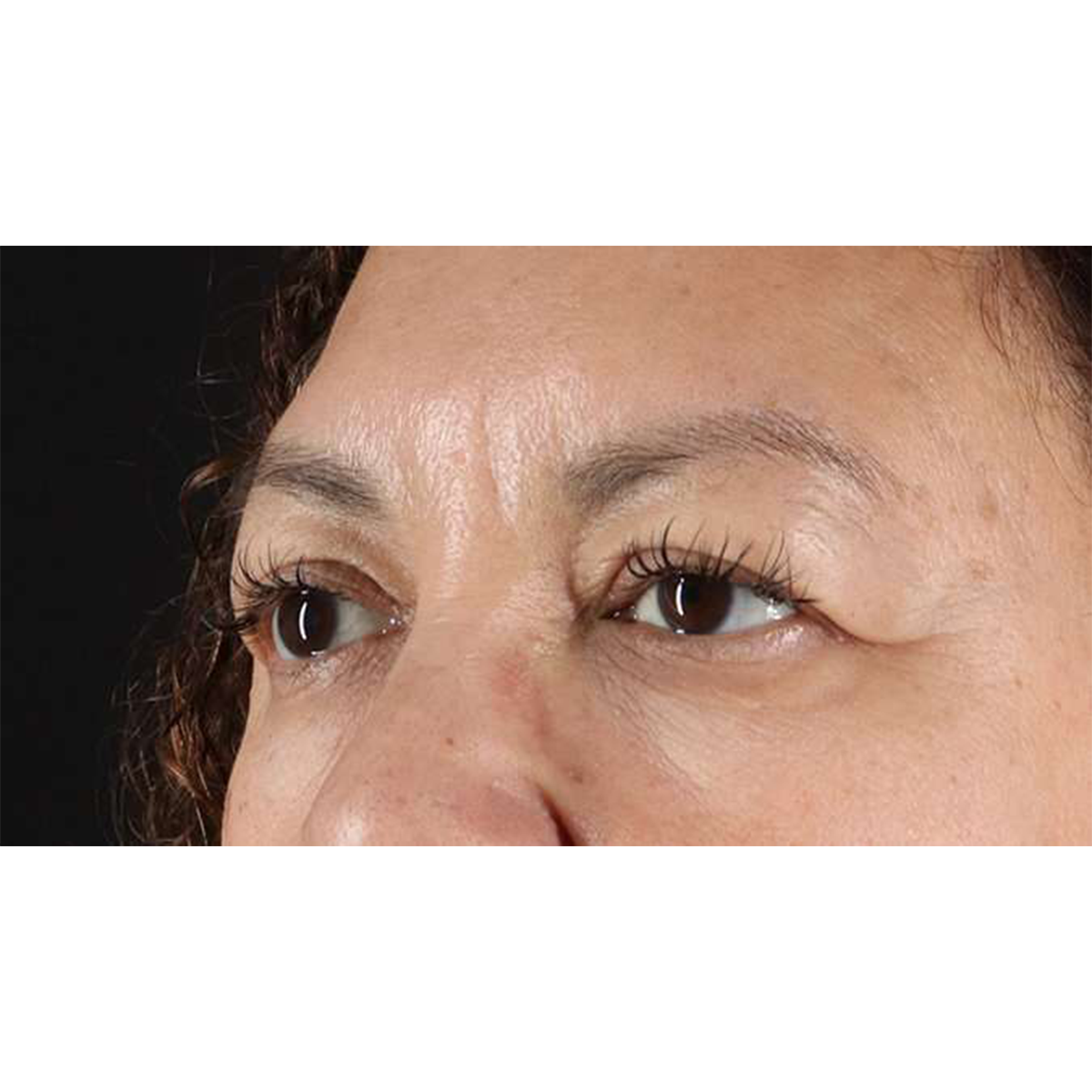 Eyelid Surgery Before & After Patient #2001