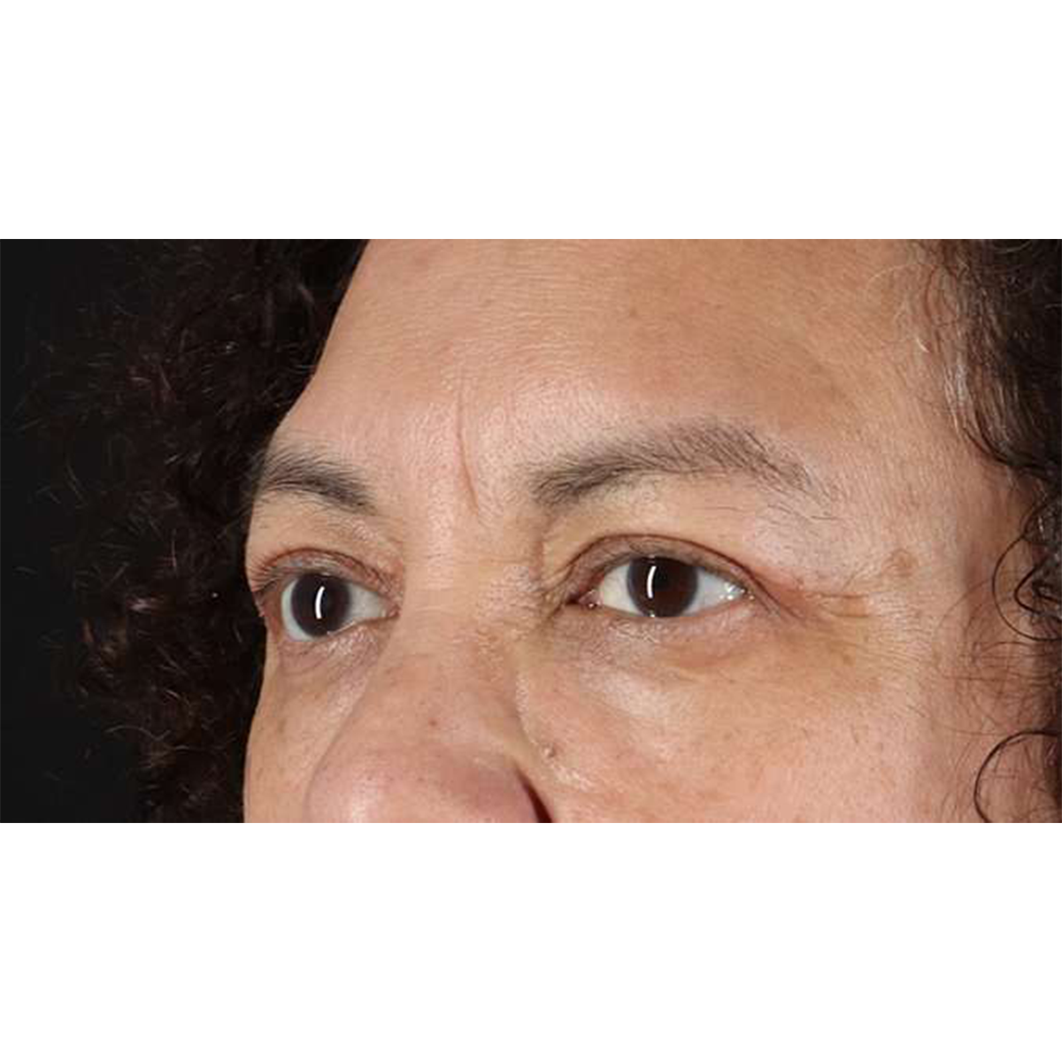 Eyelid Surgery Before & After Patient #2001