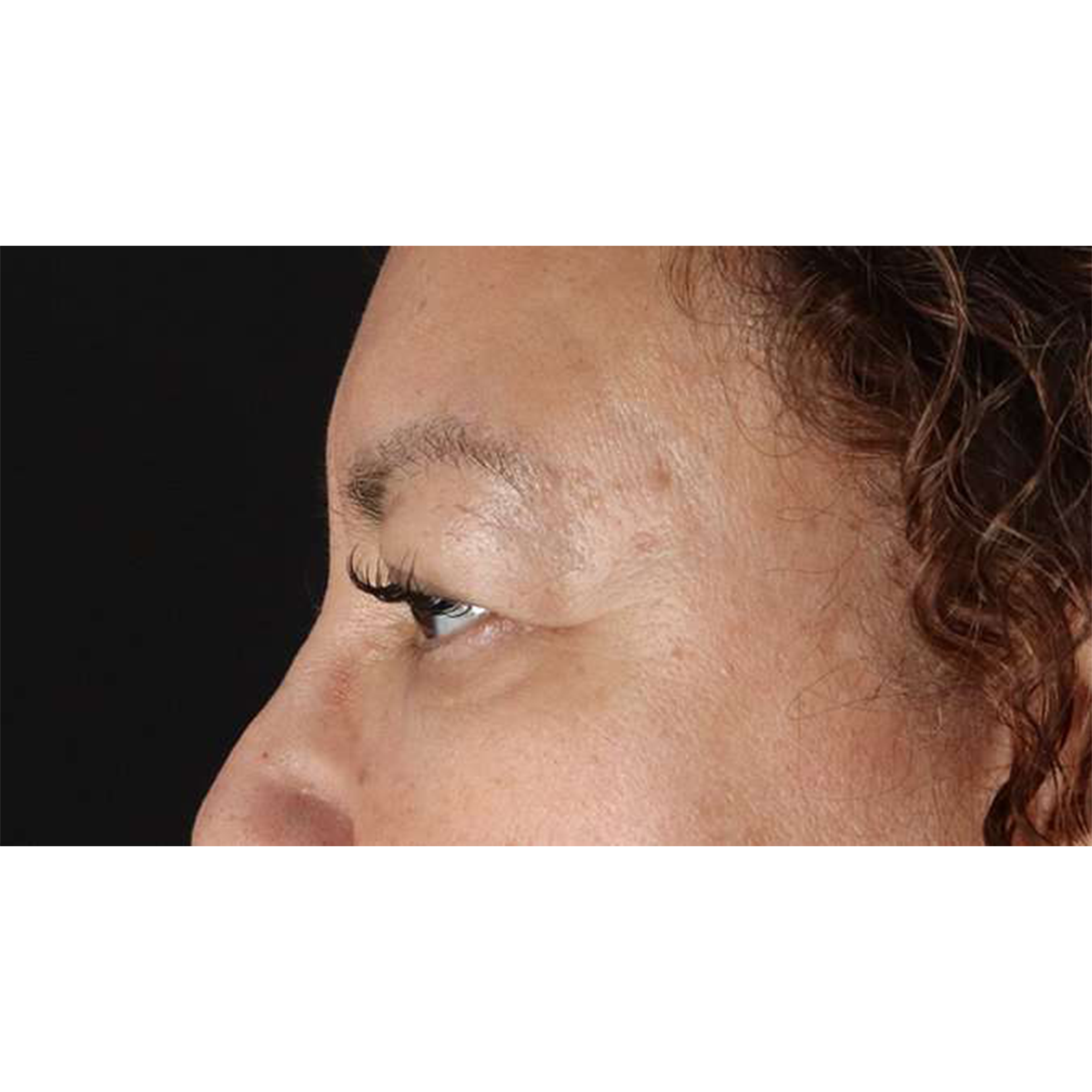 Eyelid Surgery Before & After Patient #2001