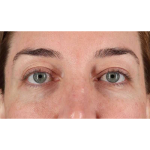 Eyelid Surgery Before & After Patient #2012