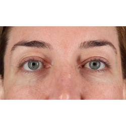 Eyelid Surgery Before & After Patient #2012