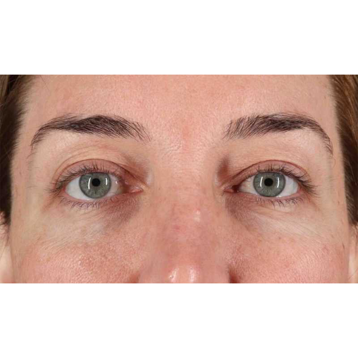 Eyelid Surgery Before & After Patient #2012