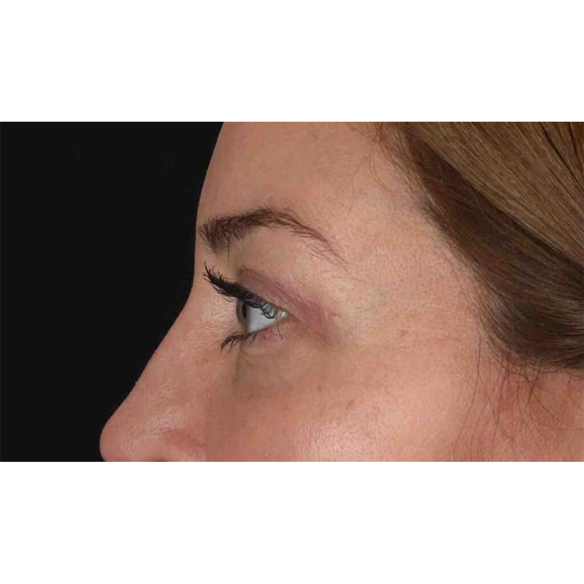 Eyelid Surgery Before & After Patient #2012