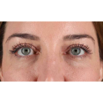 Eyelid Surgery Before & After Patient #2012