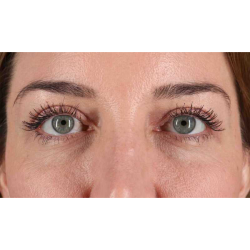 Eyelid Surgery Before & After Patient #2012