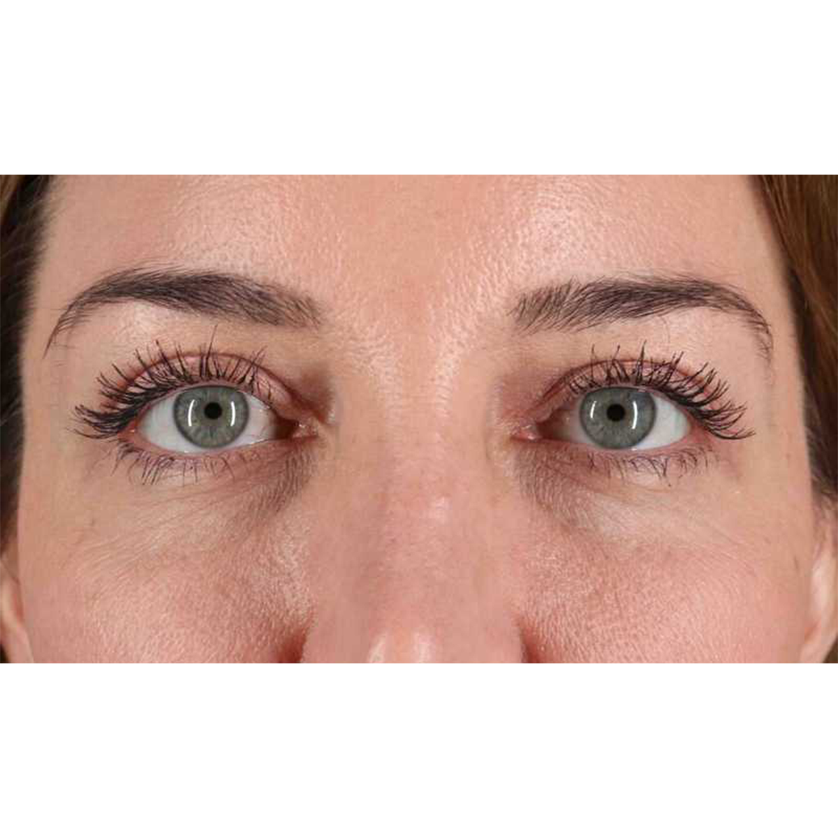 Eyelid Surgery Before & After Patient #2012