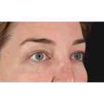 Eyelid Surgery Before & After Patient #2012