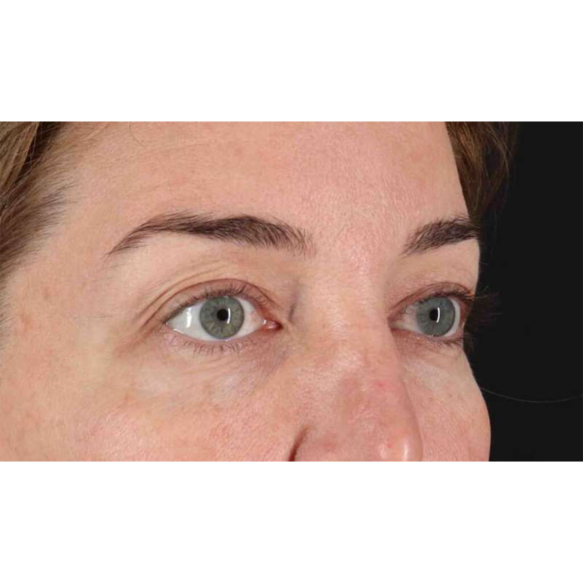 Eyelid Surgery Before & After Patient #2012