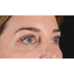 Eyelid Surgery Before & After Patient #2012
