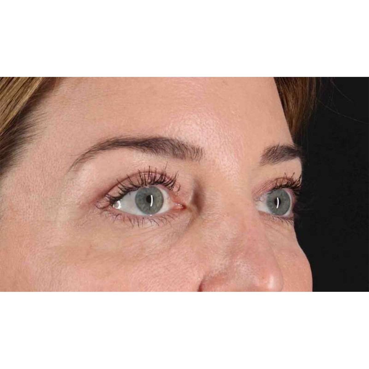 Eyelid Surgery Before & After Patient #2012