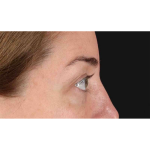 Eyelid Surgery Before & After Patient #2012