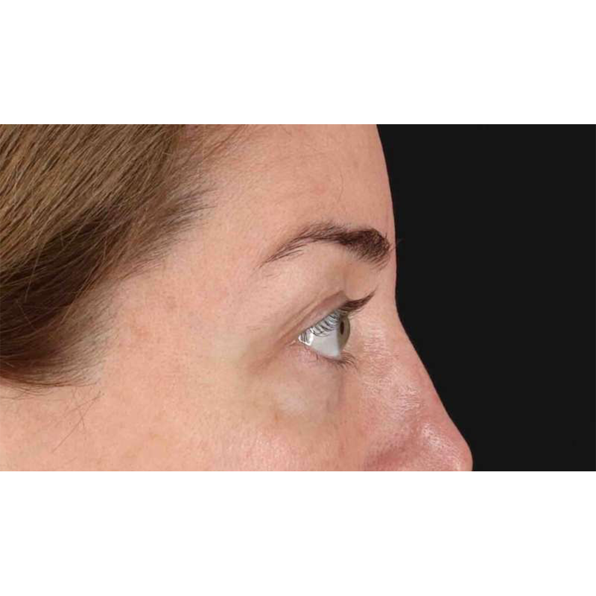 Eyelid Surgery Before & After Patient #2012