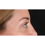 Eyelid Surgery Before & After Patient #2012
