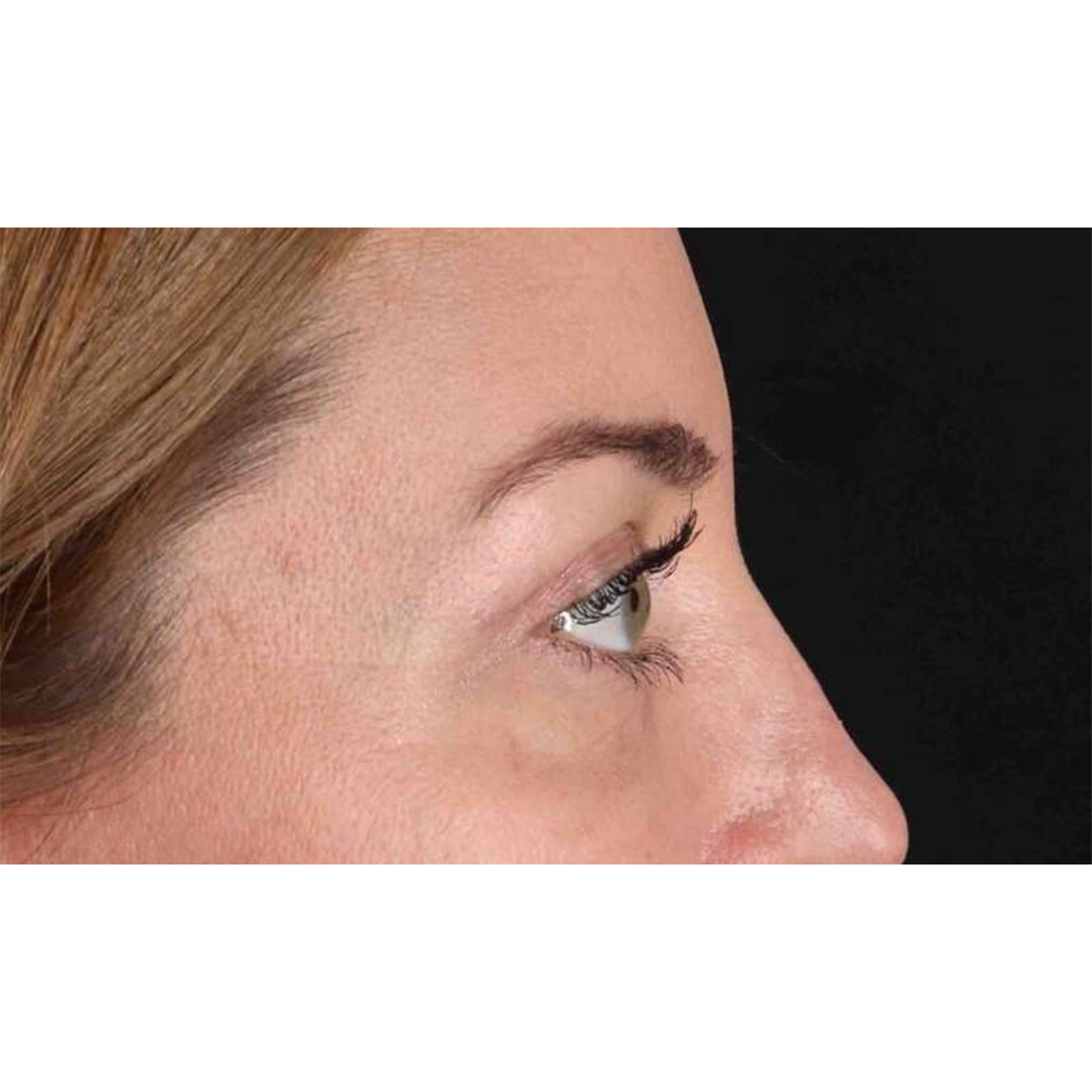 Eyelid Surgery Before & After Patient #2012