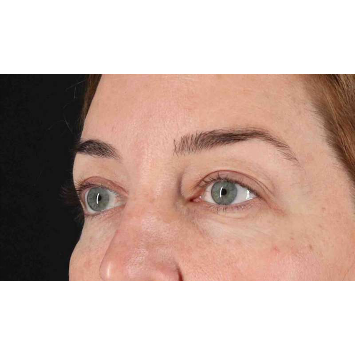 Eyelid Surgery Before & After Patient #2012