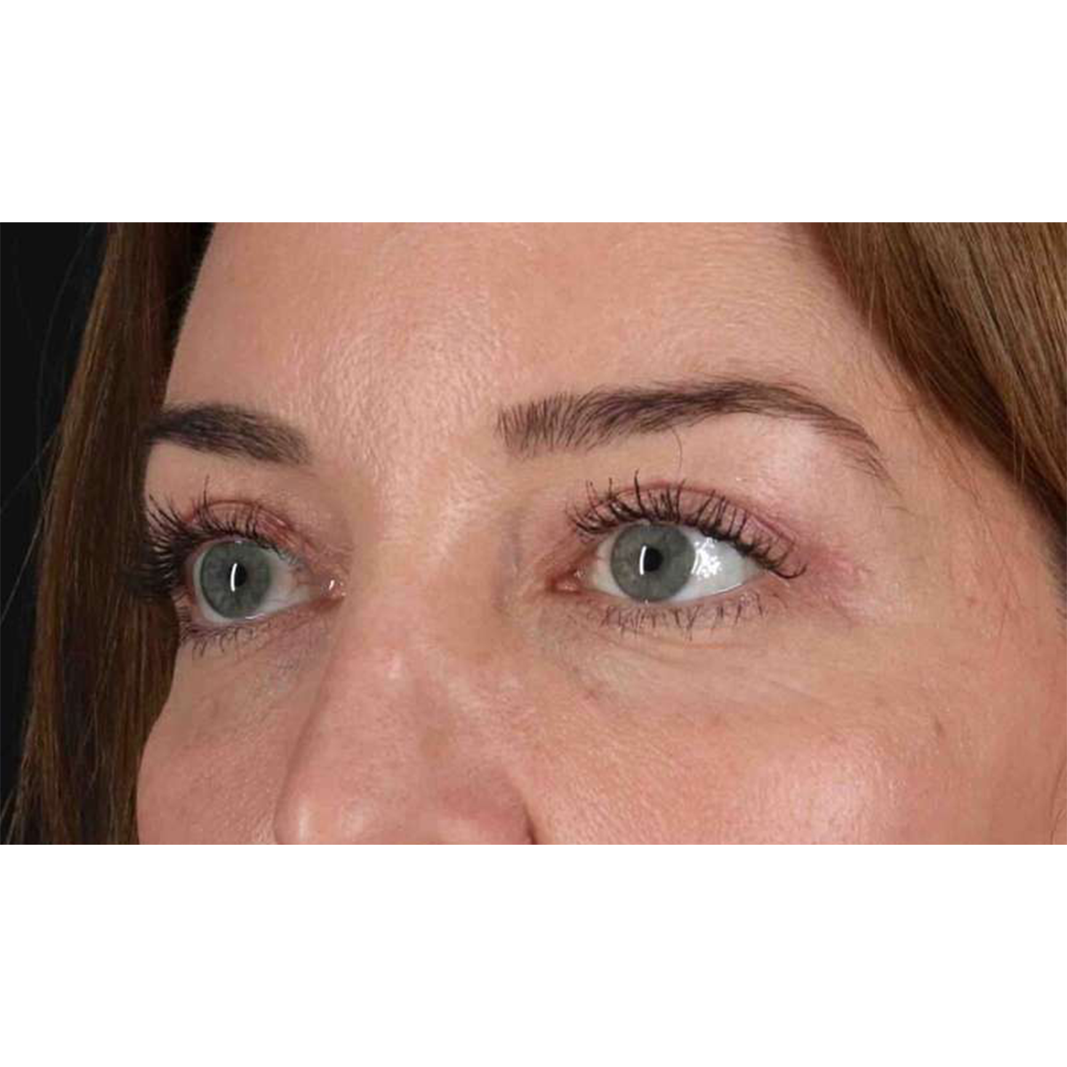 Eyelid Surgery Before & After Patient #2012