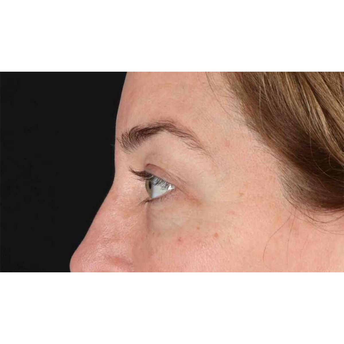 Eyelid Surgery Before & After Patient #2012