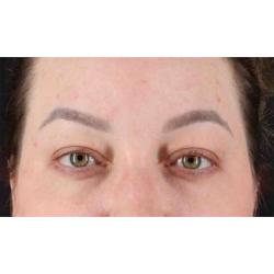 Eyelid Surgery Before & After Patient #2023