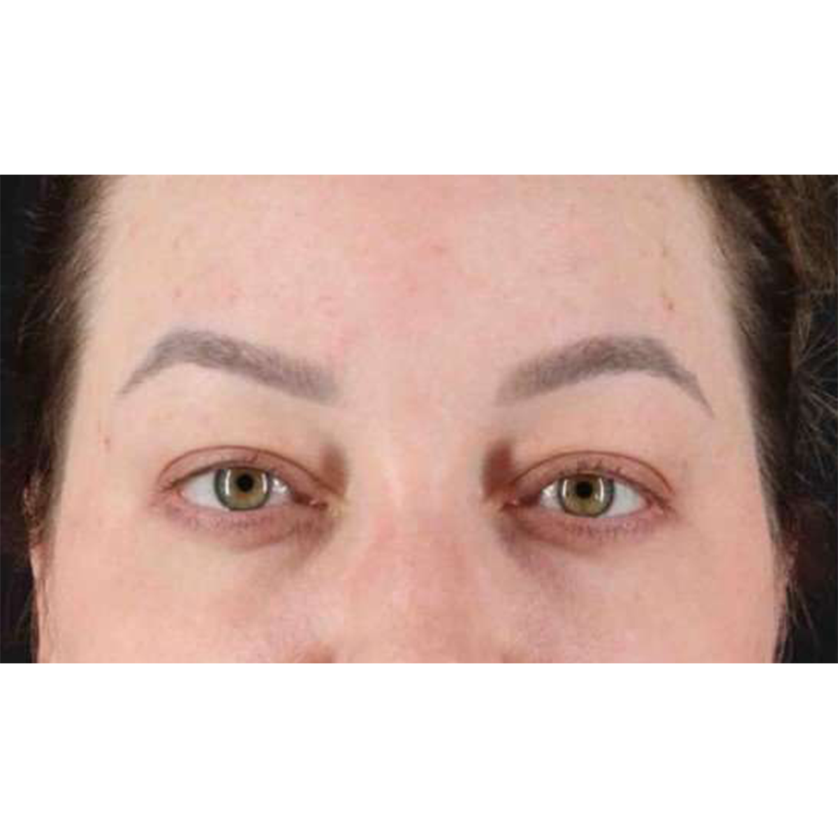 Eyelid Surgery Before & After Patient #2023