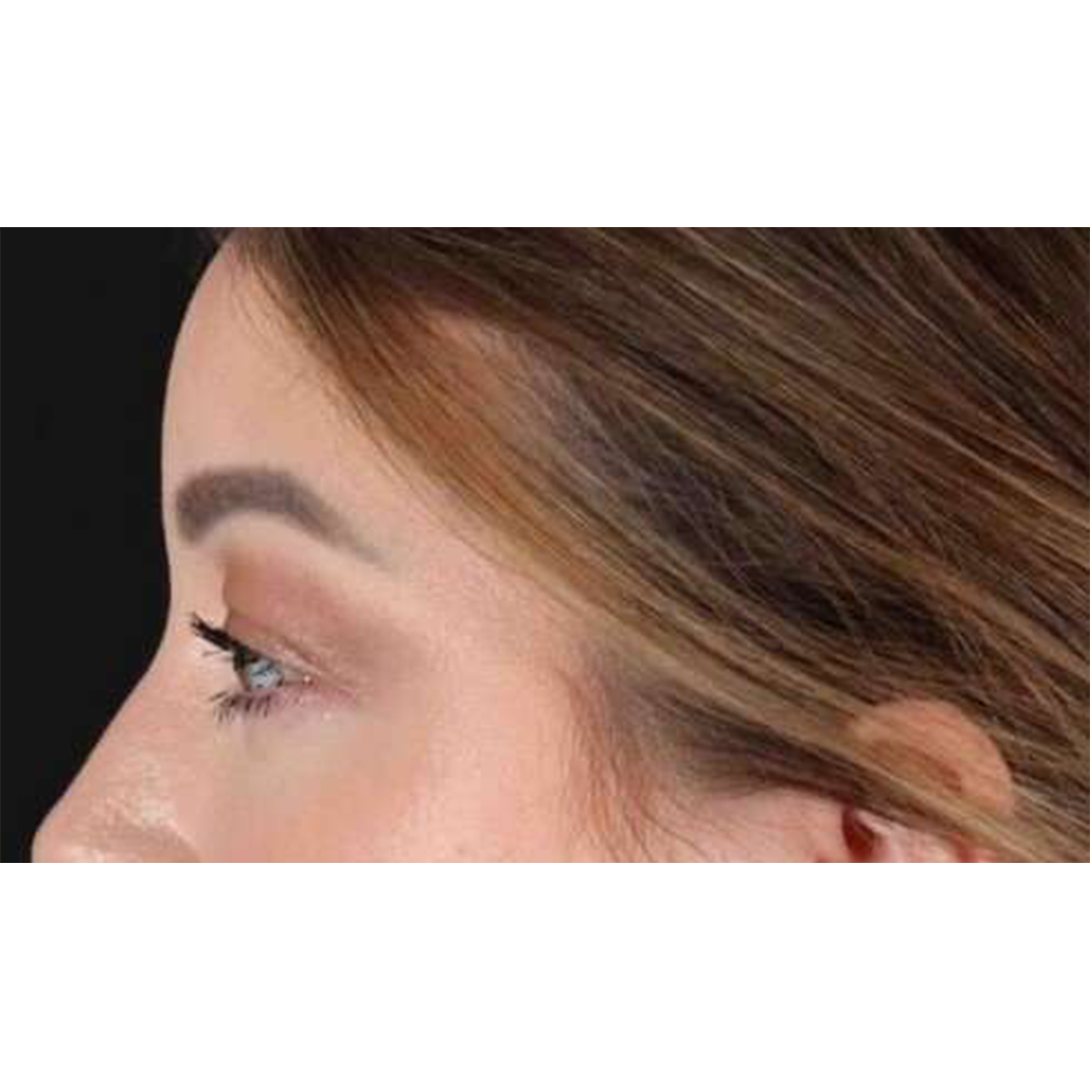 Eyelid Surgery Before & After Patient #2023