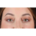 Eyelid Surgery Before & After Patient #2023