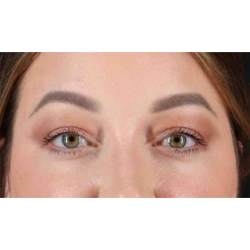 Eyelid Surgery Before & After Patient #2023