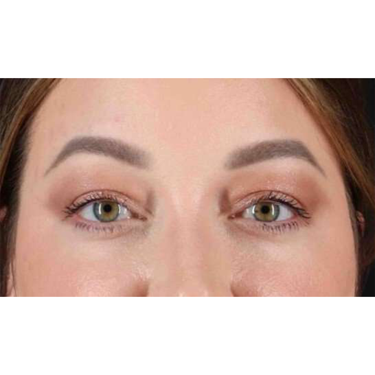 Eyelid Surgery Before & After Patient #2023