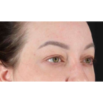 Eyelid Surgery Before & After Patient #2023