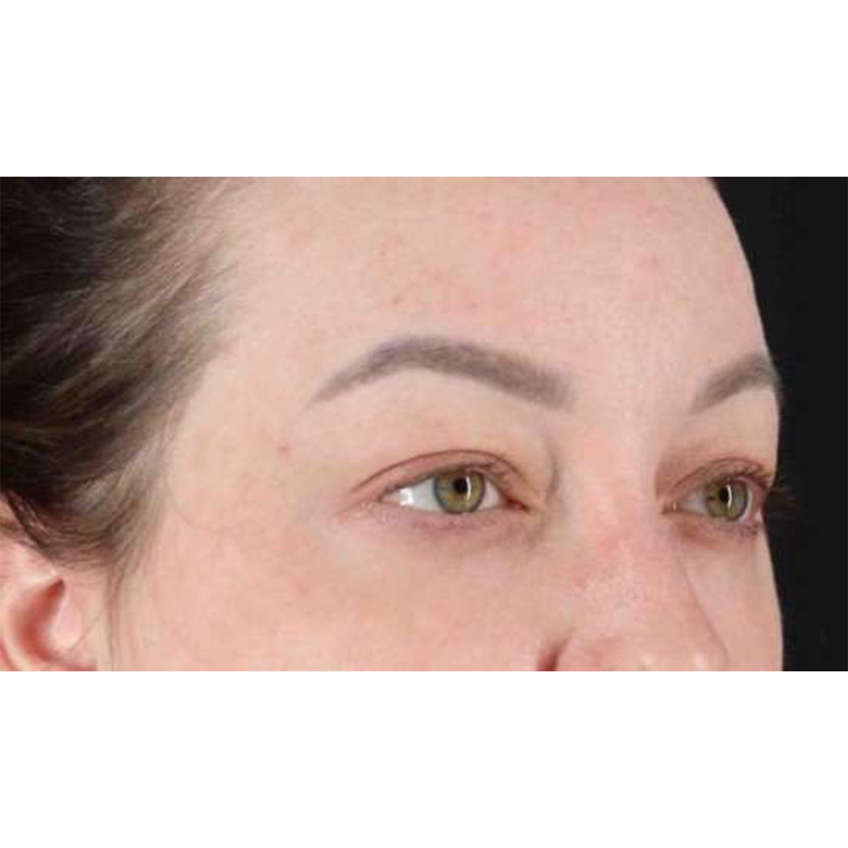 Eyelid Surgery Before & After Patient #2023