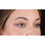Eyelid Surgery Before & After Patient #2023
